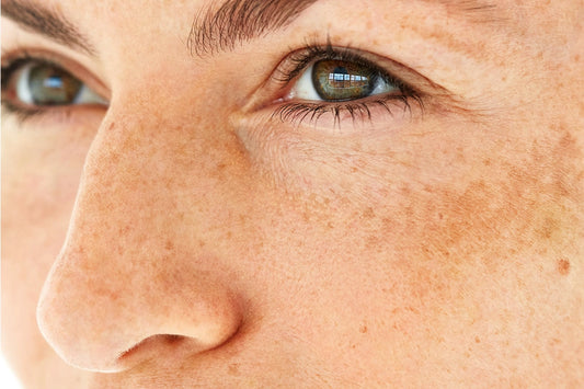 Hyperpigmentation