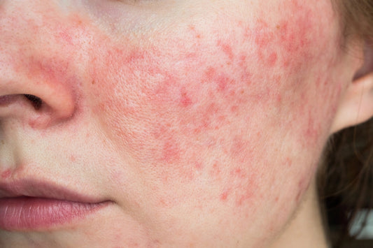 Rosacea